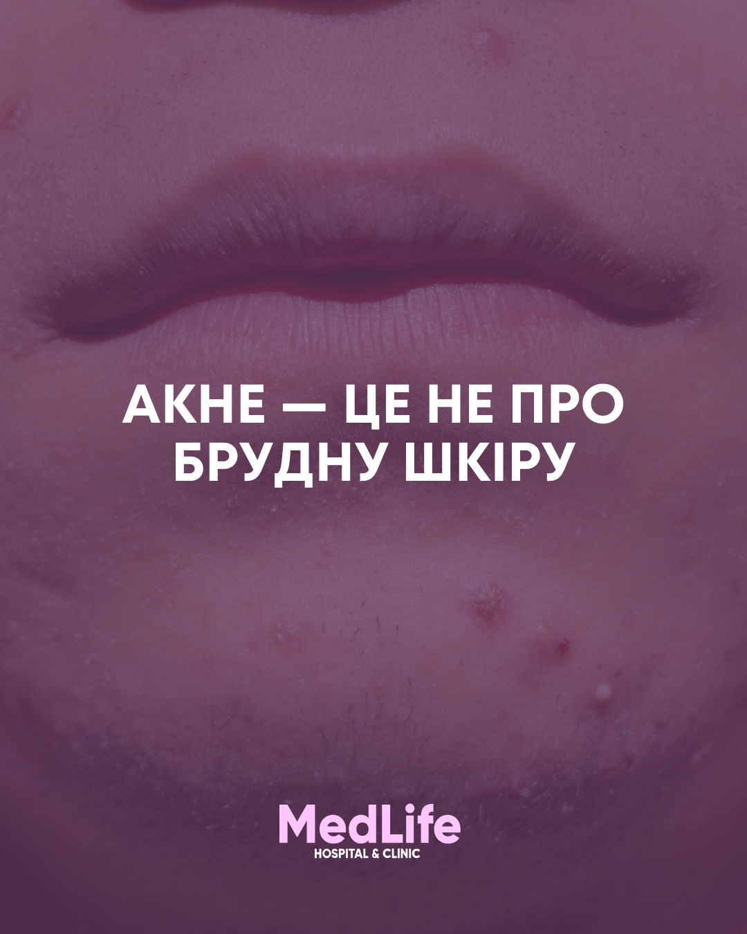Акне — хронічне захворювання шкіри